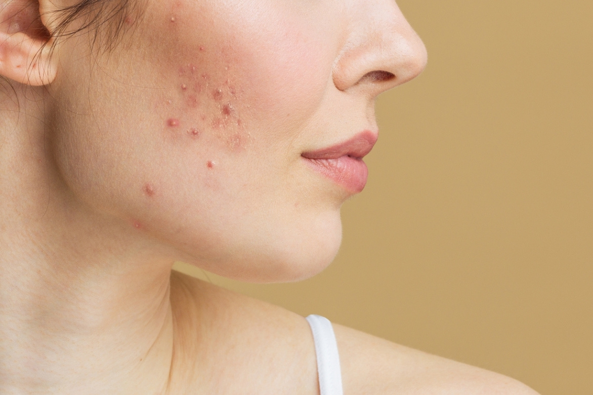 accutane-quiz
