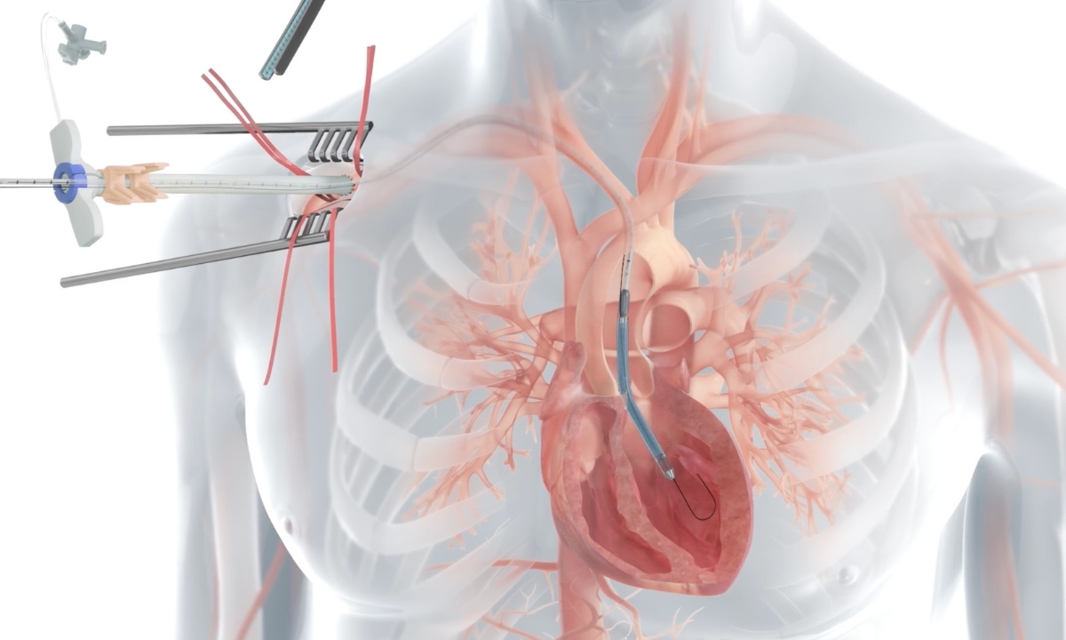 impella-5-5-quiz